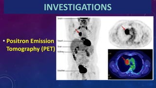 INVESTIGATIONS
• Positron Emission
Tomography (PET)
 
