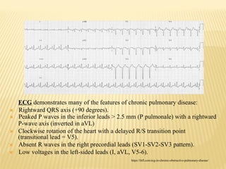 Extreme Counterclockwise Rotation Ecg Bronchoobstructive syndrome.pptx very imp | PPTX