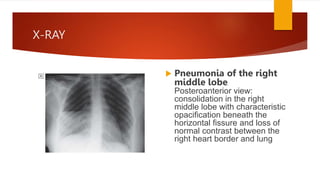 X-RAY
 Pneumonia of the right
middle lobe.
Posteroanterior view:
consolidation in the right
middle lobe with characteristic
opacification beneath the
horizontal fissure and loss of
normal contrast between the
right heart border and lung
 
