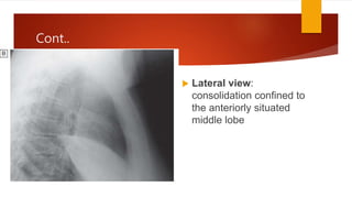 Cont..
 Lateral view:
consolidation confined to
the anteriorly situated
middle lobe
 