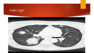 Halo sign
 
