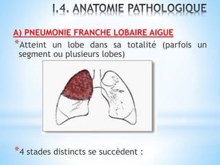 A) PNEUMONIE FRANCHE LOBAIRE AIGUE
*Atteint un lobe dans sa totalité (parfois un
segment ou plusieurs lobes)
*4 stades distincts se succèdent :
 