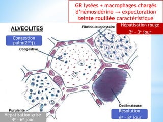 GR lysées + macrophages chargés
d’hémosidérine → expectoration
teinte rouillée caractéristique
Hépatisation rouge
2e – 3e jour
Hépatisation grise
4e – 6e jour
Résolution
6e – 8e jour
Congestion
pulm(2ersj)
 