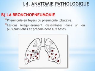 B) LA BRONCHOPNEUMONIE
*Pneumonie en foyers ou pneumonie lobulaire.
*Lésions irrégulièrement disséminées dans un ou
plusieurs lobes et prédominent aux bases.
 