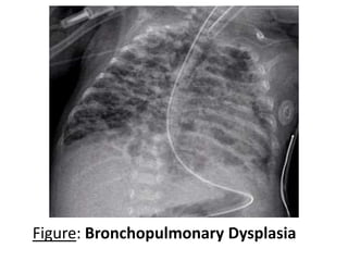 Figure: Bronchopulmonary Dysplasia
 