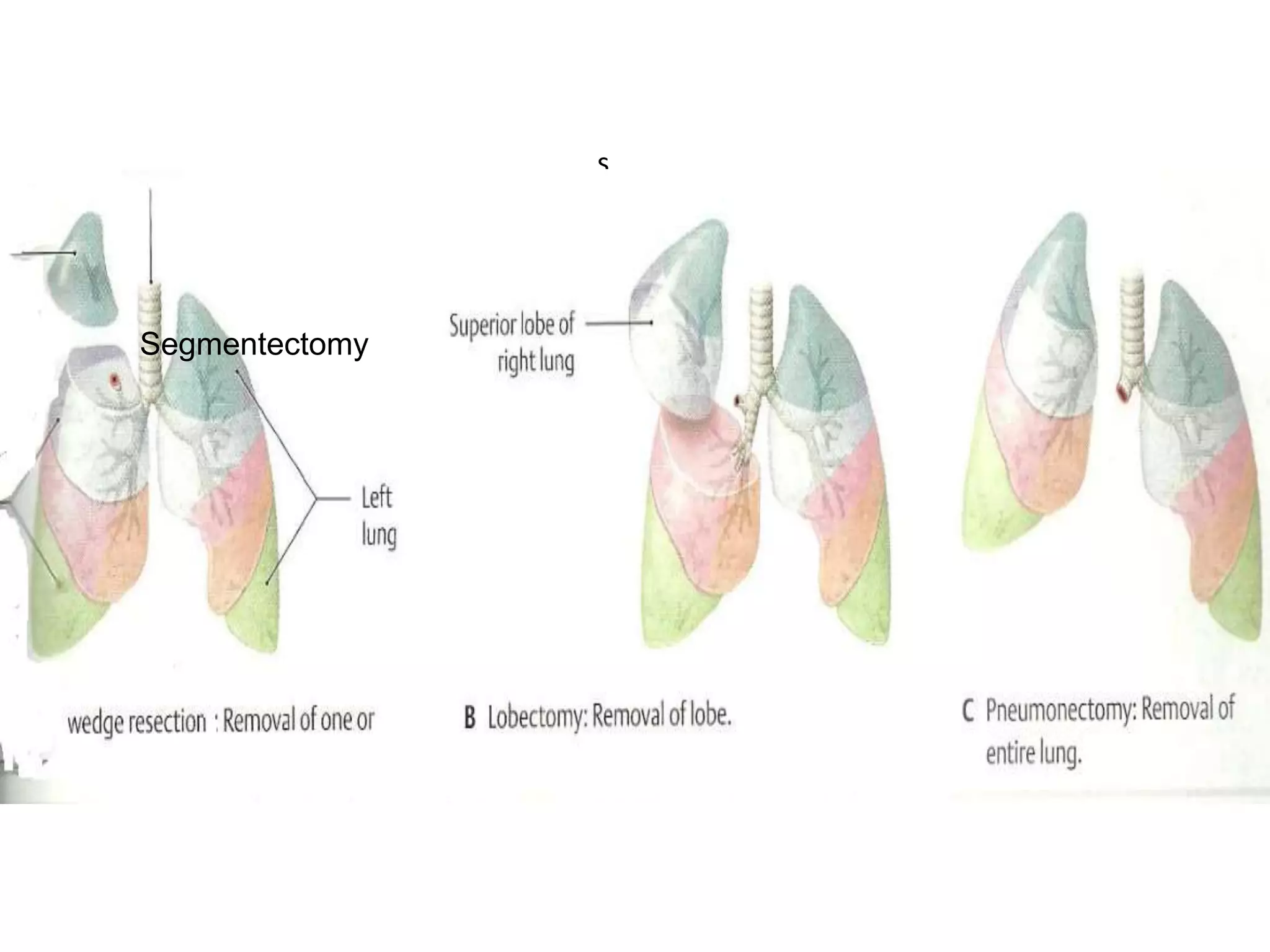 Open Segmentectomy BRONCHOPULMONARY SEGMENTS OF THE LUNG | PPTX