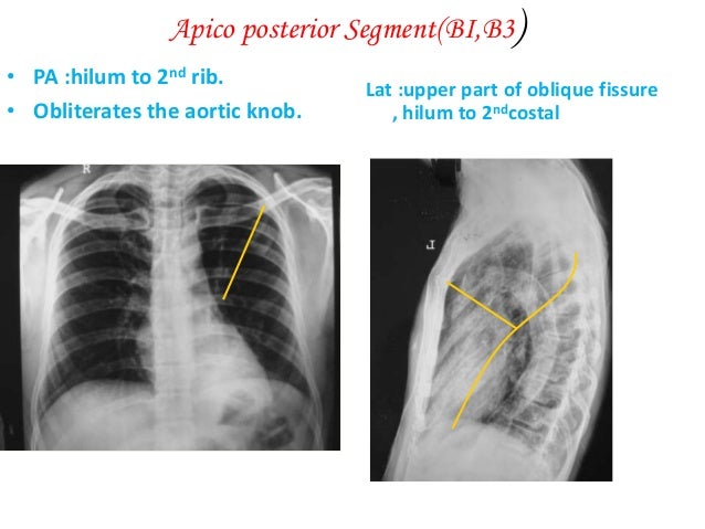 Bronchopulmonary Segments Of The Lung