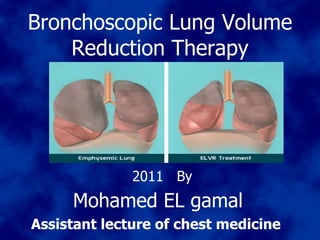 Bronchoscopic Lung Volume Reduction Therapy 2011  By Mohamed EL gamal   Assistant lecture of chest medicine  