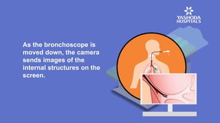 As the bronchoscope is
moved down, the camera
sends images of the
internal structures on the
screen.
 