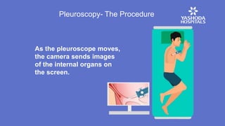 As the pleuroscope moves,
the camera sends images
of the internal organs on
the screen.
Pleuroscopy- The Procedure
 