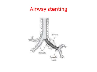 Airway stenting
 