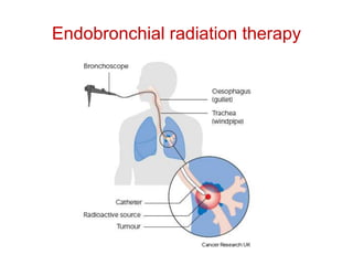 Endobronchial radiation therapy
 