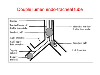 Double lumen endo-tracheal tube
 