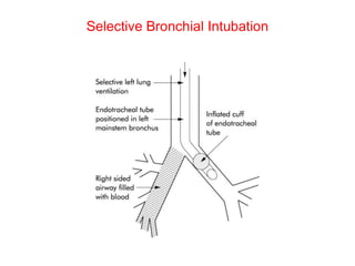 Selective Bronchial Intubation
 