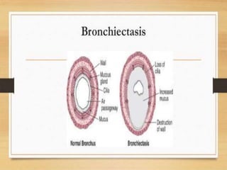 Bronciactasis 