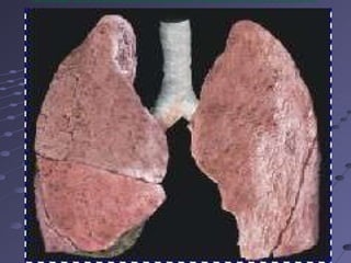 nervios y salen    las dos venas pulmonares y los vasos linf á ticos, constituyendo en su conjunto la ra í z del pulm ó n).   