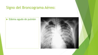 Signo del Broncograma Aéreo:
 Edema agudo de pulmón
 