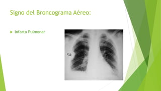 Signo del Broncograma Aéreo:
 Infarto Pulmonar
 