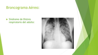 Broncograma Aéreo:
 Síndrome de Distres
respiratorio del adulto:
 