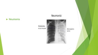 Neumonia
 