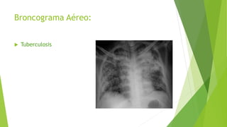 Broncograma Aéreo:
 Tuberculosis
 