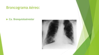 Broncograma Aéreo:
 Ca. Bronquioloalveolar
 