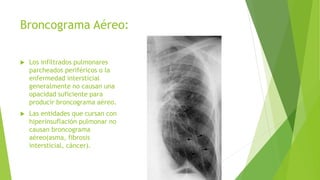Broncograma Aéreo:
 Los infiltrados pulmonares
parcheados periféricos o la
enfermedad intersticial
generalmente no causan una
opacidad suficiente para
producir broncograma aéreo.
 Las entidades que cursan con
hiperinsuflación pulmonar no
causan broncograma
aéreo(asma, fibrosis
intersticial, cáncer).
 