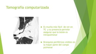 Tomografía computarizada
 Es mucho más fácil de ver en
TC y su presencia permite
asegurar que la lesión es
intrapulmonar
 Bronquios periféricos visibles en
la mayor parte del campo
pulmonar
 