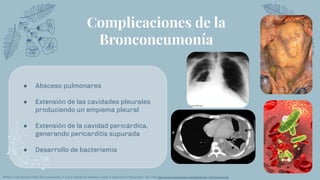 Complicaciones de la
Bronconeumonía
● Absceso pulmonares
● Extensión de las cavidades pleurales
produciendo un empiema pleural
● Extensión de la cavidad pericárdica,
generando pericarditis supurada
● Desarrollo de bacteriemia
RPablo Cortés Borrego (2001) Bronconeumonía: ¿A qué se reﬁeren los pediatras cuando la diagnostican? Medigraphic. Sitio web: https://www.medigraphic.com/pdfs/iner/in-2001/in013a.pdf
 