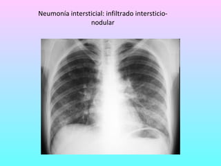 Neumonía intersticial: infiltrado intersticio-nodular 
