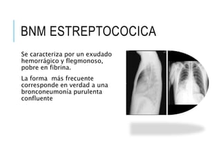 BNM ESTREPTOCOCICA
Se caracteriza por un exudado
hemorrágico y flegmonoso,
pobre en fibrina.
La forma más frecuente
corresponde en verdad a una
bronconeumonía purulenta
confluente
 