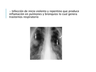 • Infección de inicio violento y repentino que produce
inflamación en pulmones y bronquios lo cual genera
trastornos respiratorio
 