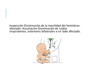 Inspección Disminución de la movilidad del hemitórax
afectado. Ascultación Disminución de ruidos
respiratorios, estertores bilaterales o en lado afectado.
 