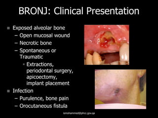 BRONJ: Clinical Presentation
 Exposed alveolar bone
– Open mucosal wound
– Necrotic bone
– Spontaneous or
Traumatic
 Extractions,
periodontal surgery,
apicoectomy,
implant placement
 Infection
– Purulence, bone pain
– Orocutaneous fistula
ismohammed@phcc.gov.qa
 
