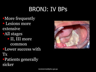 More frequently
 Lesions more
extensive
All stages
 II, III more
common
Lower success with
Tx
Patients generally
sicker
BRONJ: IV BPs
ismohammed@phcc.gov.qa
 