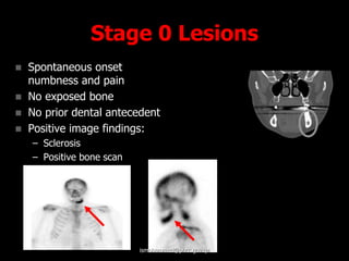 Stage 0 Lesions
 Spontaneous onset
numbness and pain
 No exposed bone
 No prior dental antecedent
 Positive image findings:
– Sclerosis
– Positive bone scan
ismohammed@phcc.gov.qa
 