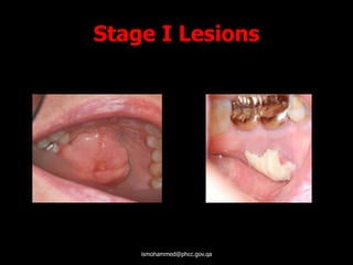 Stage I Lesions
ismohammed@phcc.gov.qa
 