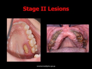 Stage II Lesions
ismohammed@phcc.gov.qa
 