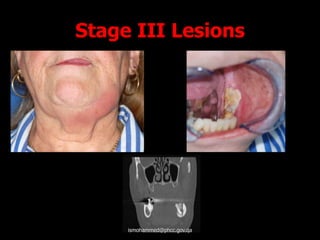 Stage III Lesions
ismohammed@phcc.gov.qa
 
