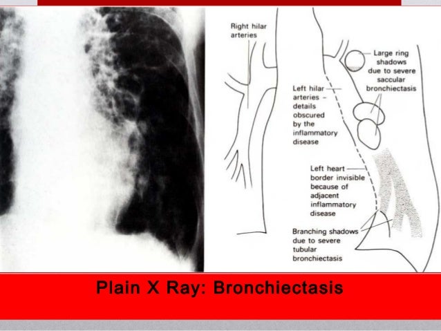 Bronkitis & Bronkiektasis