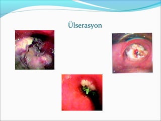 Ülserasyon
 