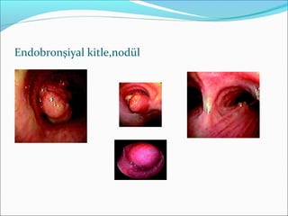 Endobronşiyal kitle,nodül
 