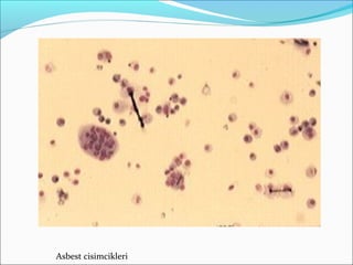 Asbest cisimcikleri
 
