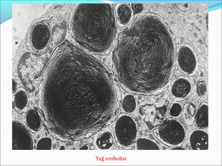 Yağ embolisi
 
