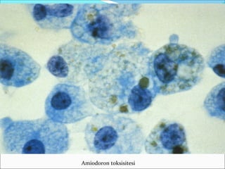 Amiodoron toksisitesi
 