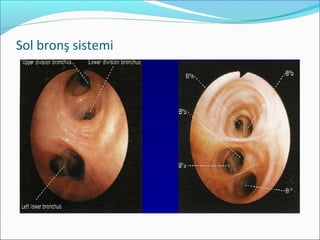 Sol bronş sistemi
 