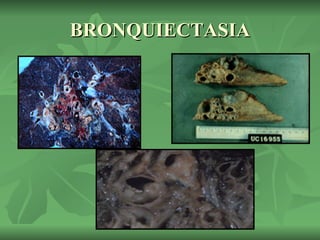 BRONQUIECTASIA 