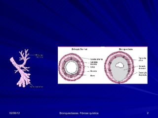 02/06/12   Bronquiectasias. Fibrose quística   2
 
