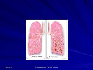02/06/12   Bronquiectasias. Fibrose quística   7
 