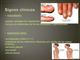 • Auscultación:

-grados variables de crepitantes
-roncus y/o sibilancias de forma localizada o generalizada


• exploración física:

-acropaquias (uñas) (+++)
-linfedema de los miembros inferiores por atrofia de los vasos
linfáticos
-derrame pleural
-bronquitis
-cifosis dorsal
 